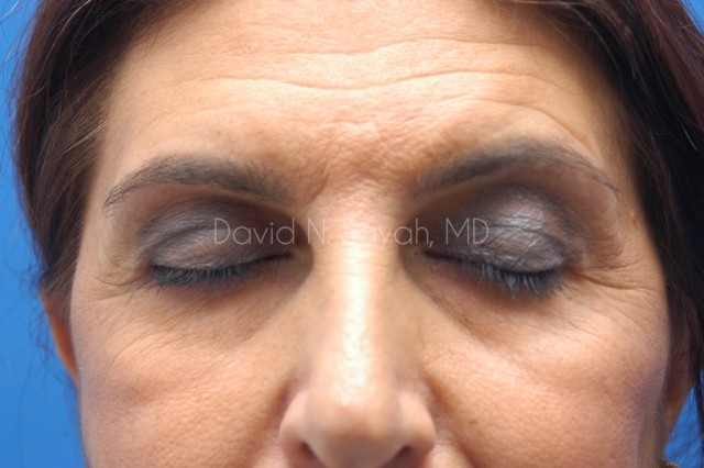 Endoscopic Brow Lift Before and After | Sayah Institute