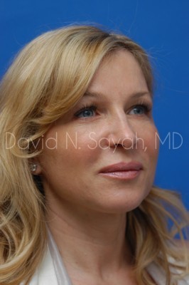 Endoscopic Brow Lift Before and After | Sayah Institute