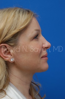 Endoscopic Brow Lift Before and After | Sayah Institute