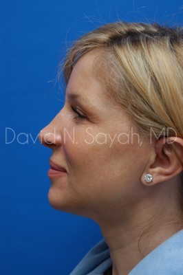 Endoscopic Brow Lift Before and After | Sayah Institute
