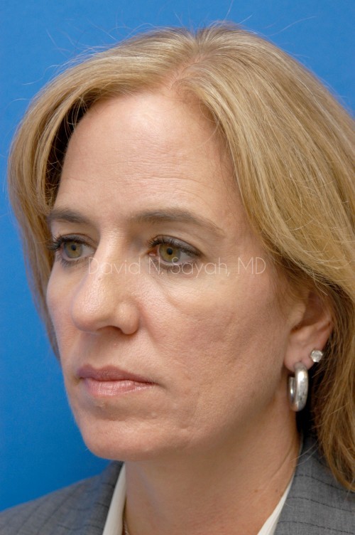 Eyelid Surgery Before and After | Sayah Institute