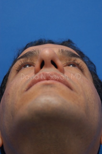 Eyelid Surgery Before and After | Sayah Institute