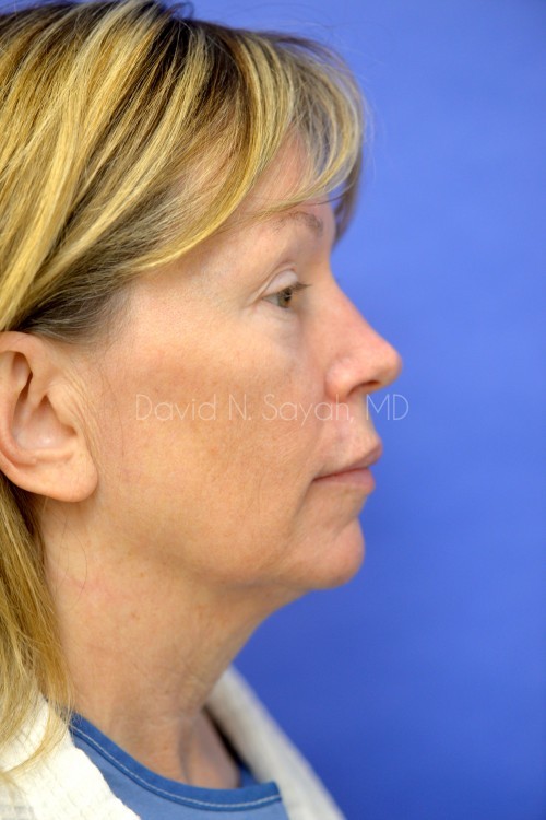 Eyelid Surgery Before and After | Sayah Institute