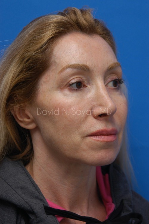 Eyelid Surgery Before and After | Sayah Institute