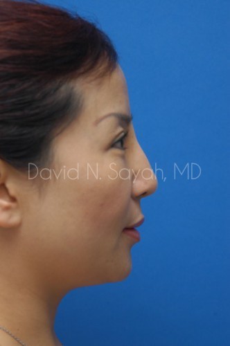 Eyelid Surgery Before and After | Sayah Institute