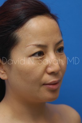 Eyelid Surgery Before and After | Sayah Institute