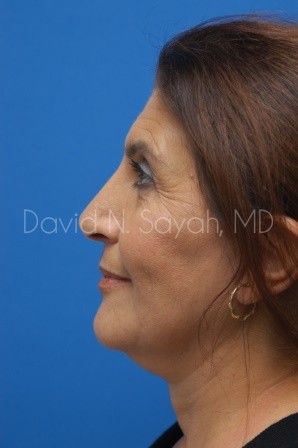 Facelift Before and After | Sayah Institute