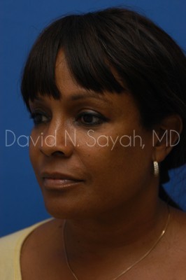 Facelift Before and After | Sayah Institute
