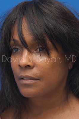 Facelift Before and After | Sayah Institute