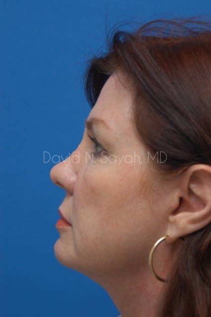 Facelift Before and After | Sayah Institute