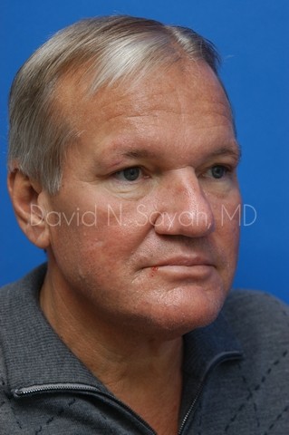 Facelift Before and After | Sayah Institute