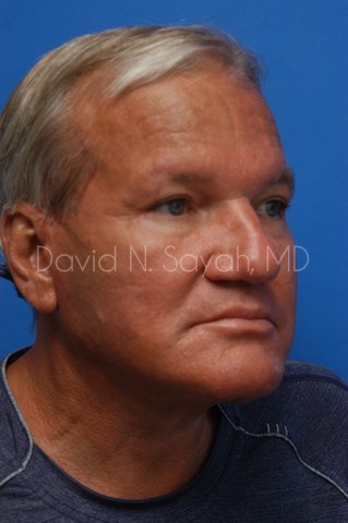 Facelift Before and After | Sayah Institute