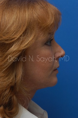Facelift Before and After | Sayah Institute