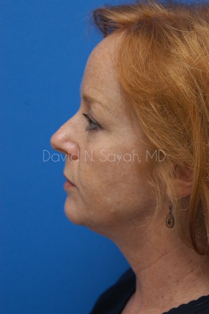 Facelift Before and After | Sayah Institute