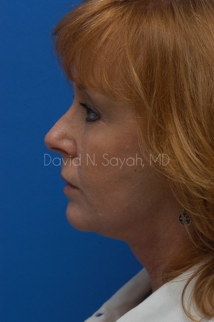 Facelift Before and After | Sayah Institute