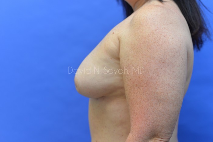Fat Injection Breast Before and After | Sayah Institute