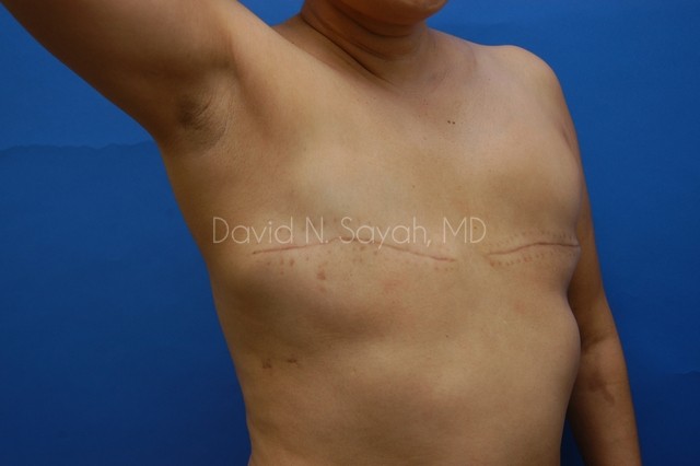 Fat Injection Breast Before and After | Sayah Institute