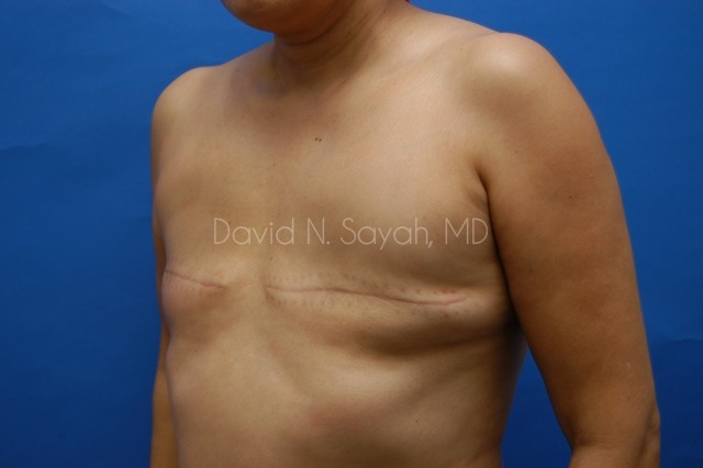 Fat Injection Breast Before and After | Sayah Institute
