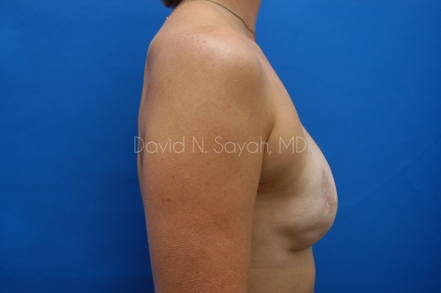 Fat Injection Breast Before and After | Sayah Institute