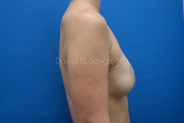 Fat Injection Breast Before and After | Sayah Institute