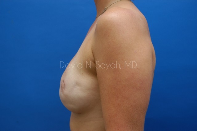 Fat Injection Breast Before and After | Sayah Institute