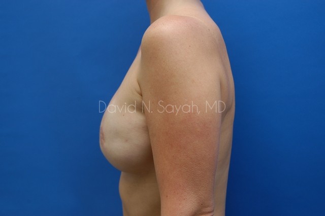 Fat Injection Breast Before and After | Sayah Institute