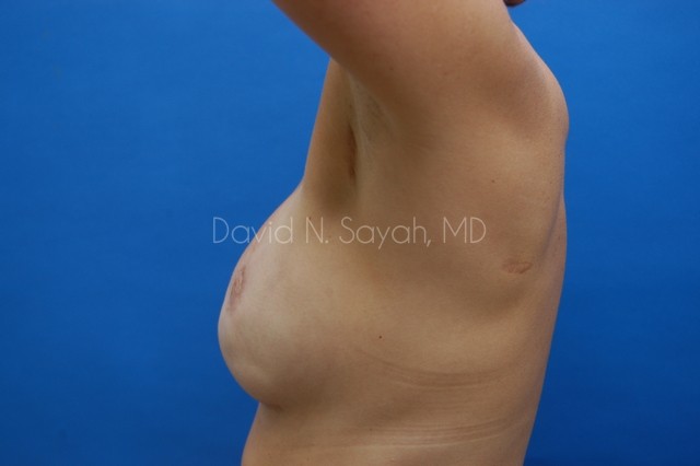 Fat Injection Breast Before and After | Sayah Institute