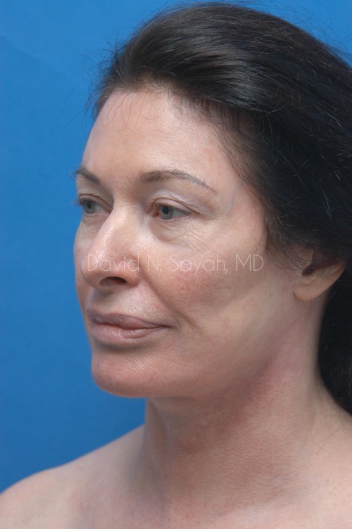 Fat Injection Face Before and After | Sayah Institute