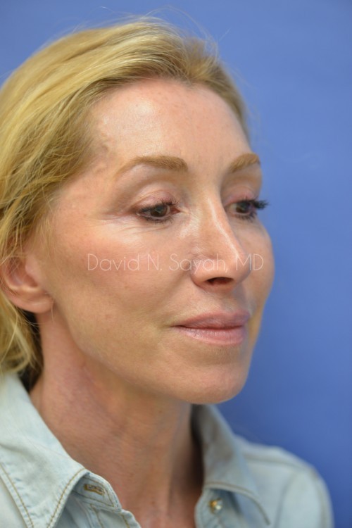 Fat Injection Face Before and After | Sayah Institute