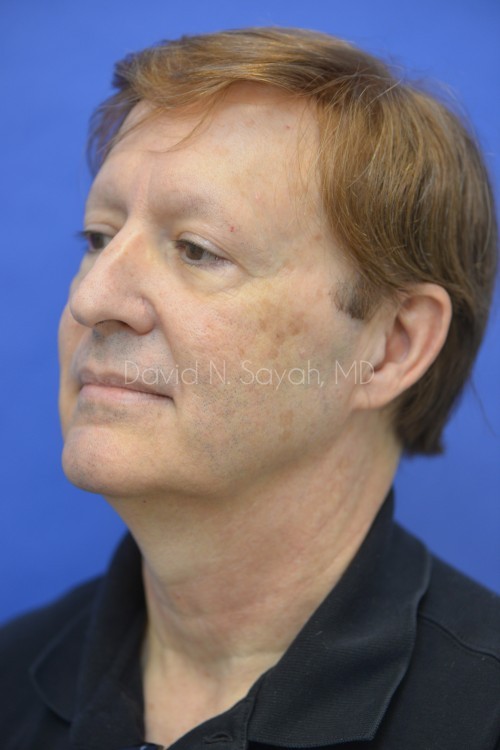 Fat Injection Face Before and After | Sayah Institute