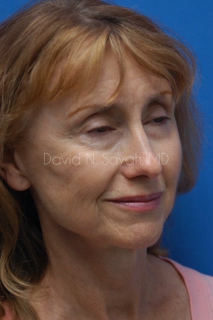 Fat Injection Face Before and After | Sayah Institute