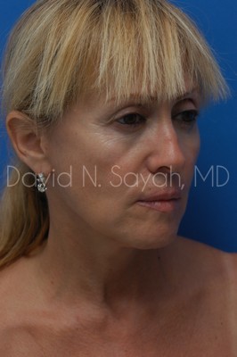 Fat Injection Face Before and After | Sayah Institute