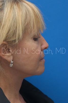 Fat Injection Face Before and After | Sayah Institute