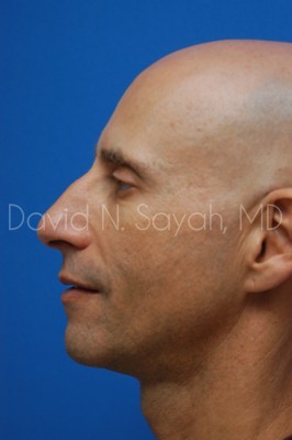 Fat Injection Face Before and After | Sayah Institute