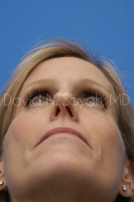Fat Injection Face Before and After | Sayah Institute