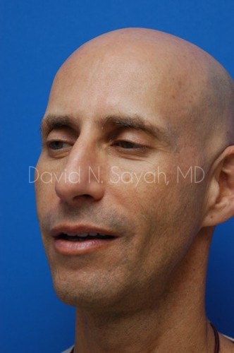Fat Injection Face Before and After | Sayah Institute