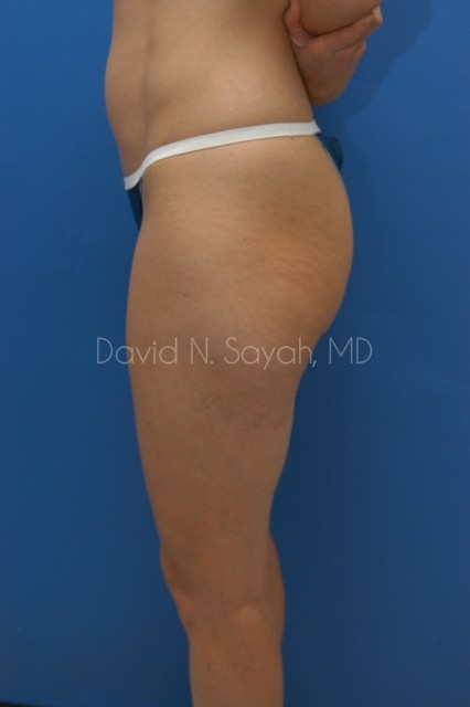 Gluteal Augmentation Before and After | Sayah Institute