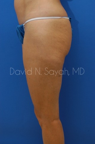 Gluteal Augmentation Before and After | Sayah Institute