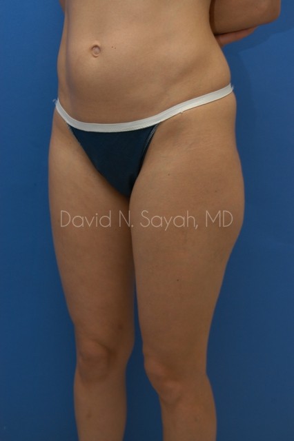 Gluteal Augmentation Before and After | Sayah Institute