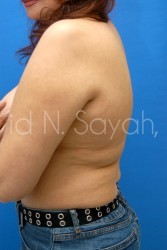 Liposuction Before and After | Sayah Institute