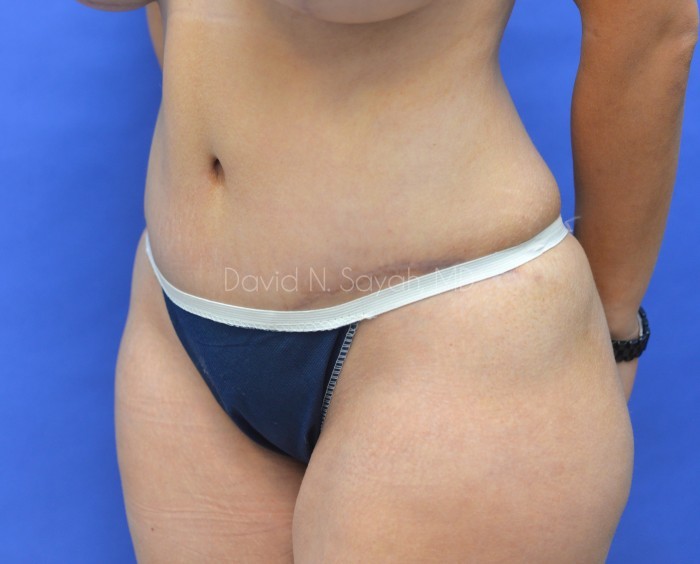 Liposuction Before and After | Sayah Institute