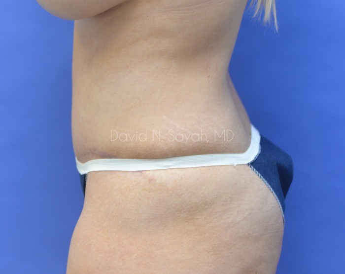 Liposuction Before and After | Sayah Institute