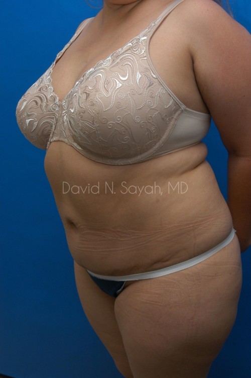Liposuction Before and After | Sayah Institute