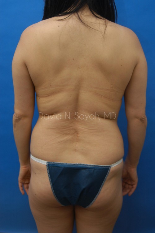 Liposuction Before and After | Sayah Institute