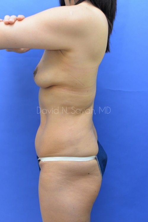 Liposuction Before and After | Sayah Institute