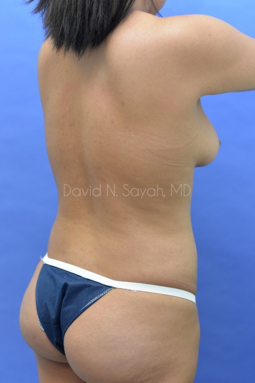Liposuction Before and After | Sayah Institute