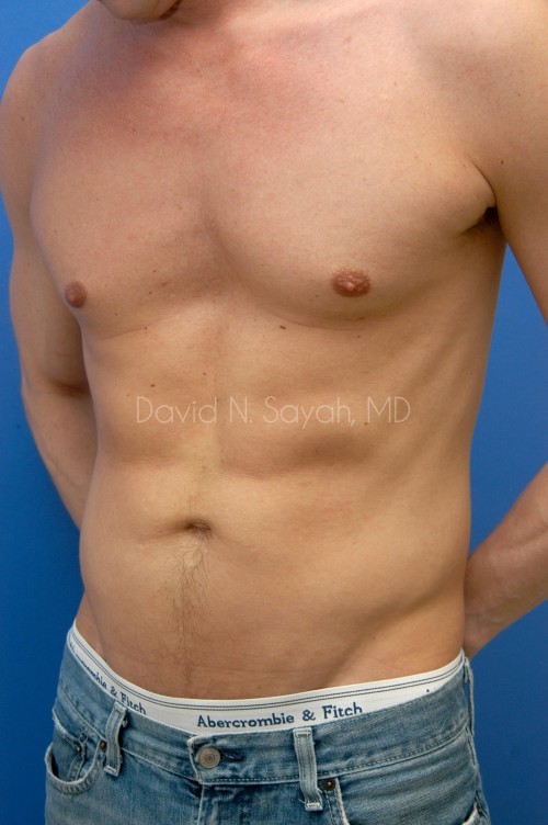 Liposuction Before and After | Sayah Institute