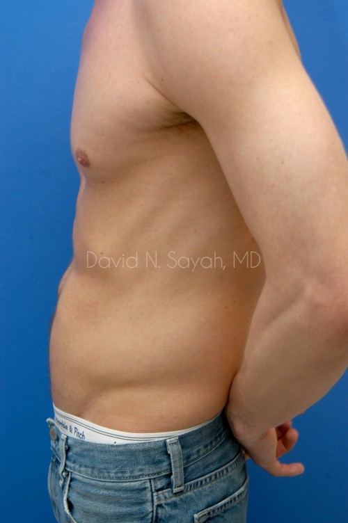 Liposuction Before and After | Sayah Institute