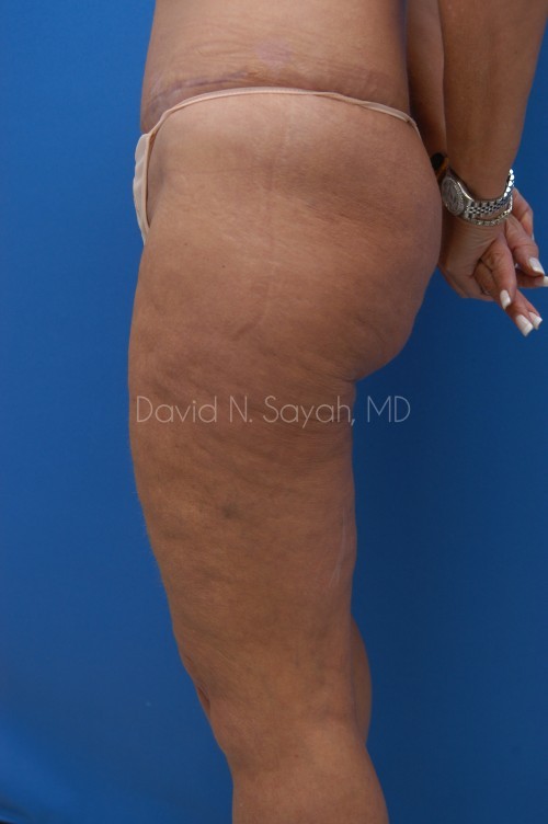 Liposuction Before and After | Sayah Institute