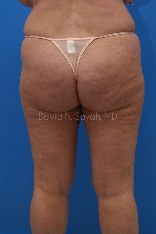 Liposuction Before and After | Sayah Institute